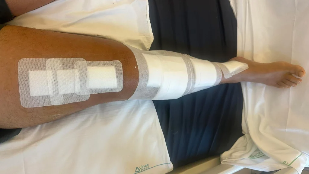 chuck-keels-broken-leg-italy